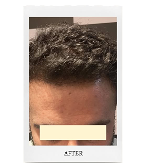 Hair Transplant