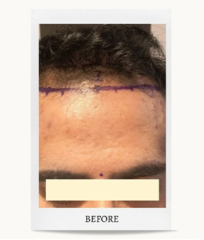 Hair Transplant