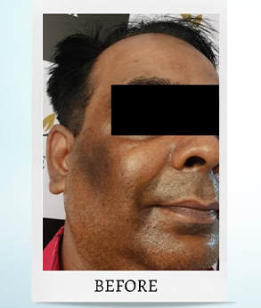 Melasma